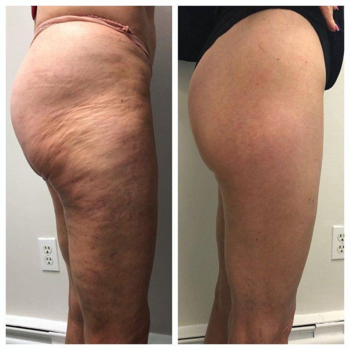 Dr. James 7 Days Slimming Anti-Cellulite Gel USA